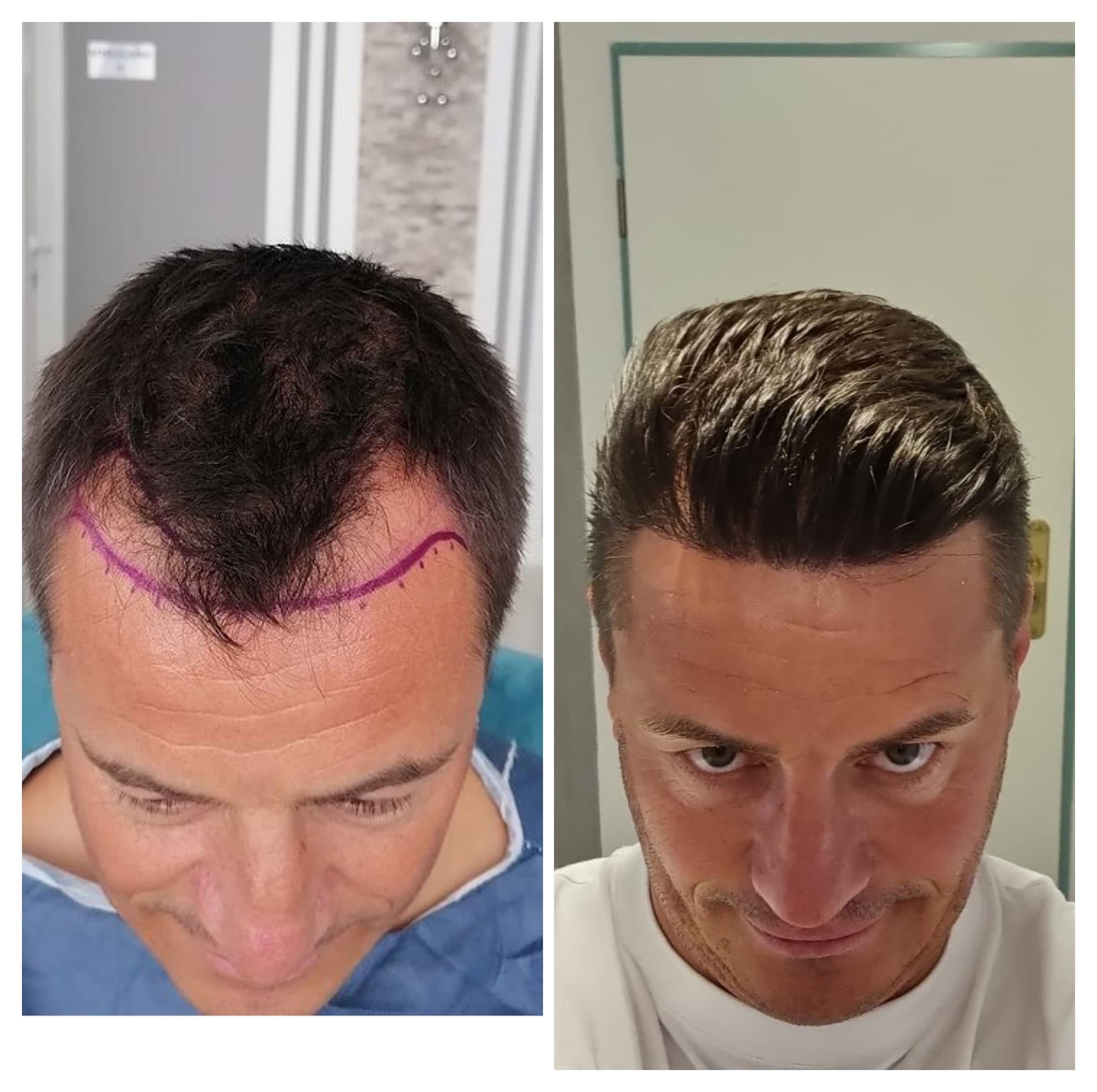 Hair Transplant UK – Reviews: See Why Patients Recommend Westminster