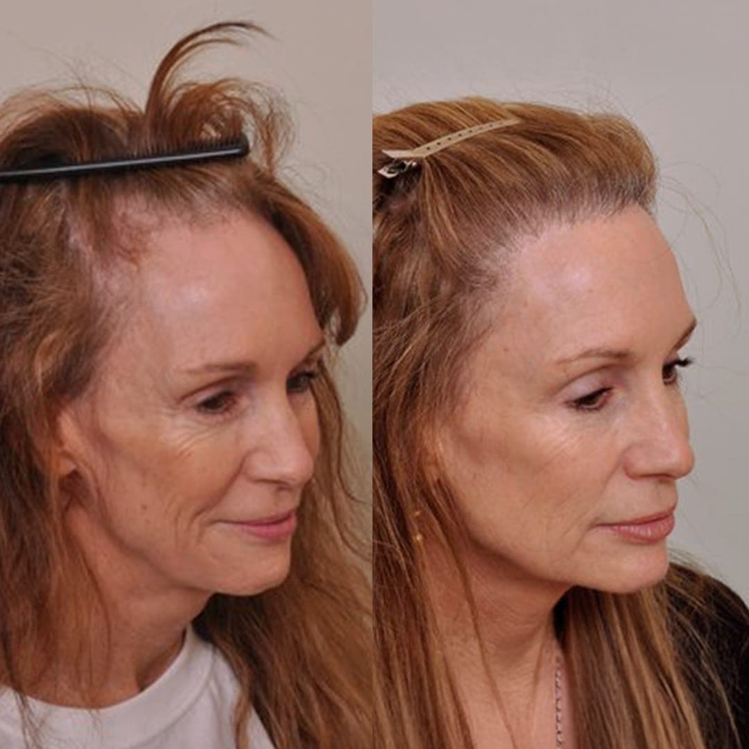 Expert Hair Transplant Procedures by Westminster Medical Group Specialists