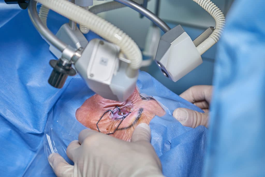 Affordable and Safe: Secrets to the Right Lasik Istanbul Cost